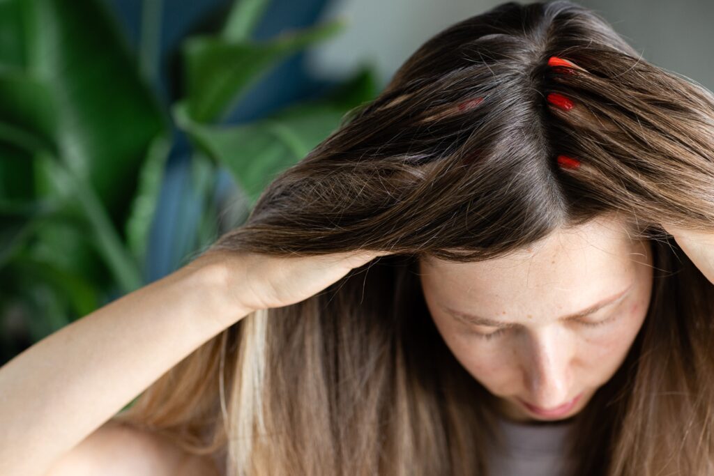 Mulher com caspa no cabelo, coçando o cabelo